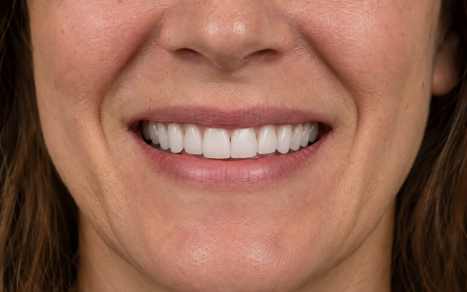 porcelain-veneers-after-reeves-birmingham-al.png