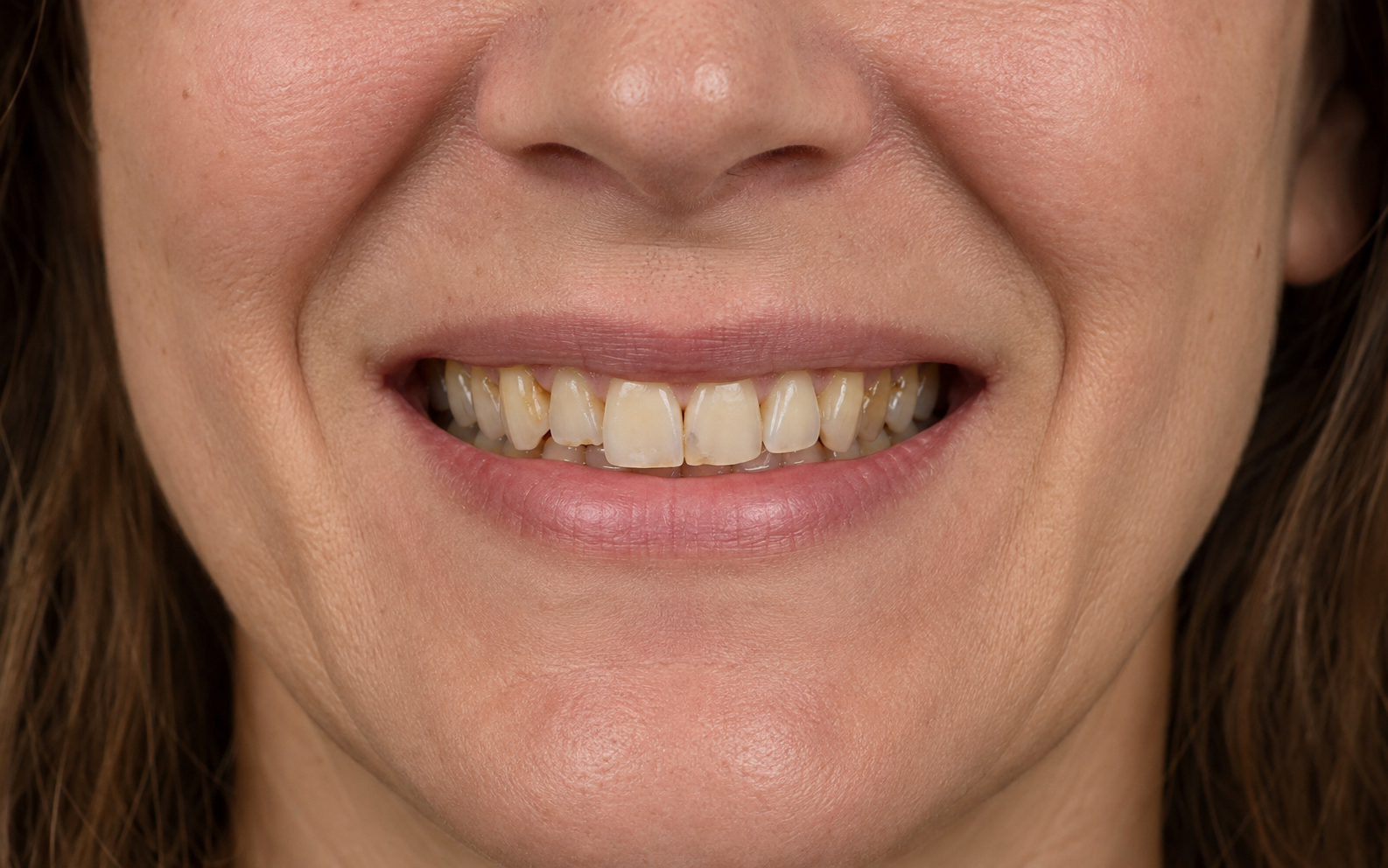 AI-generated placeholder showing a smile before porcelain veneers
